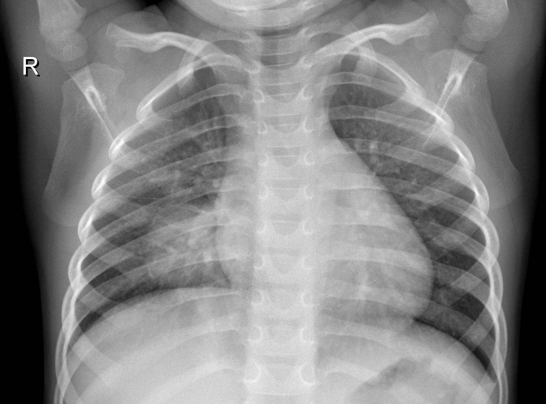 Chest X-Ray Classification Project